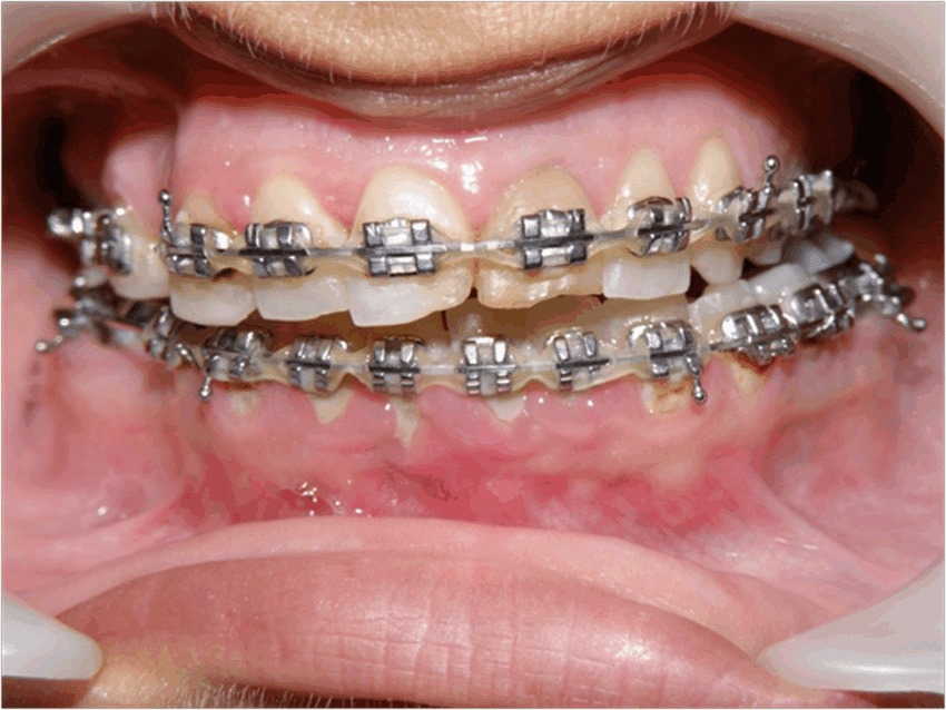Fixed orthodontics